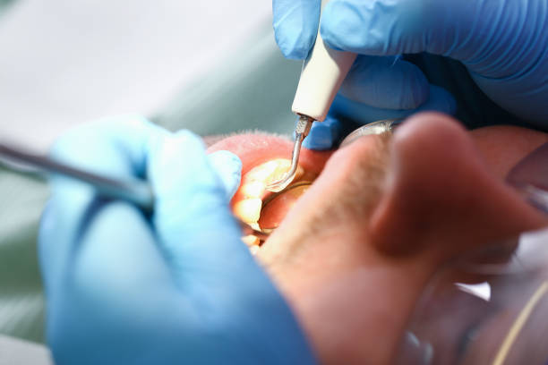 Best Emergency Root Canal Treatment in Zebulon, NC